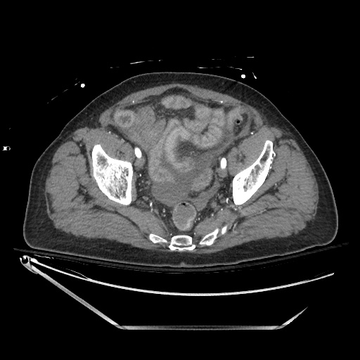 Closed loop obstruction due to adhesive band, resulting in small bowel ischemia and resection (Radiopaedia 83835-99023 B 131).jpg
