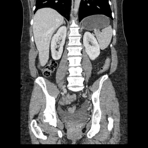 Closed loop small bowel obstruction (Radiopaedia 65403-74451 B 70).jpg