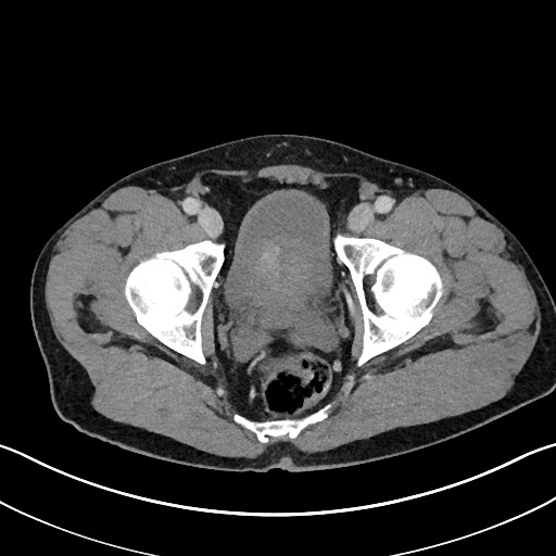 Closed loop small bowel obstruction - internal hernia (Radiopaedia 57806-64778 B 118).jpg