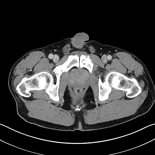 Closed loop small bowel obstruction - internal hernia (Radiopaedia 57806-64778 B 127).jpg