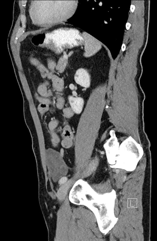 Closed loop small bowel obstruction - internal hernia (Radiopaedia 57806-64778 C 39).jpg