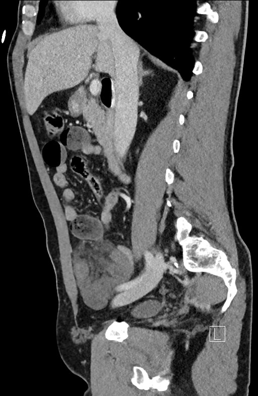 Closed loop small bowel obstruction - internal hernia (Radiopaedia 57806-64778 C 68).jpg