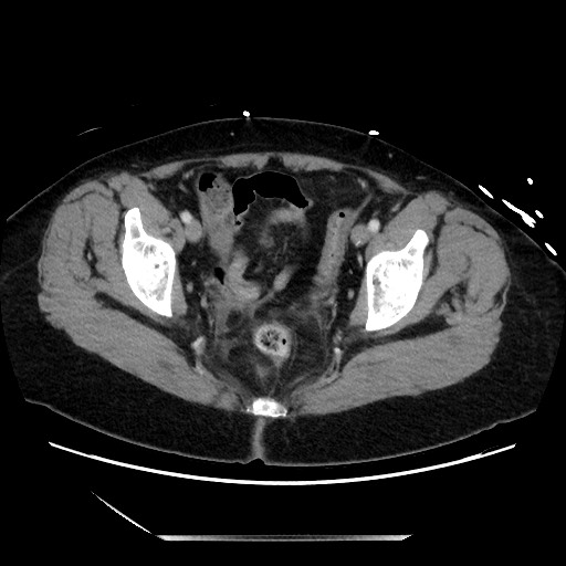 Closed loop small bowel obstruction due to adhesive bands - early and late images (Radiopaedia 83830-99014 A 137).jpg