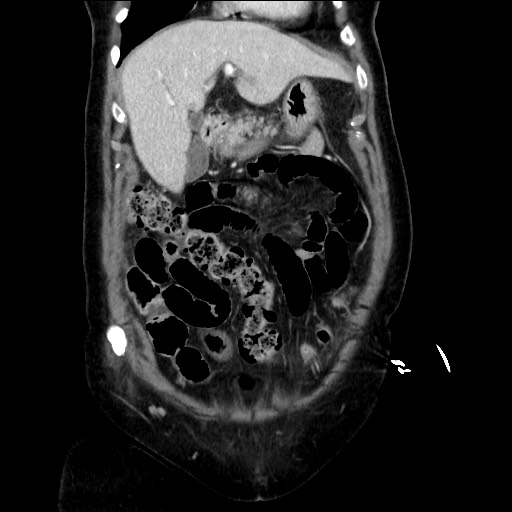 Closed loop small bowel obstruction due to adhesive bands - early and late images (Radiopaedia 83830-99014 B 39).jpg