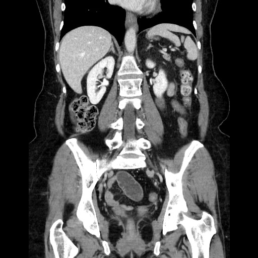 File:Closed loop small bowel obstruction due to adhesive bands - early and late images (Radiopaedia 83830-99015 B 79).jpg