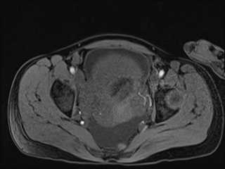 Closed loop small bowel obstruction in pregnancy (MRI) (Radiopaedia 87637-104031 G 10).jpg