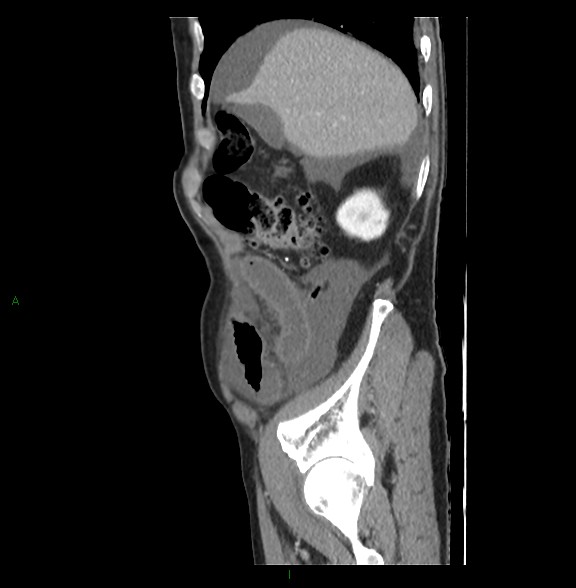 Closed loop small bowel obstruction with ischemia (Radiopaedia 84180-99456 C 21).jpg