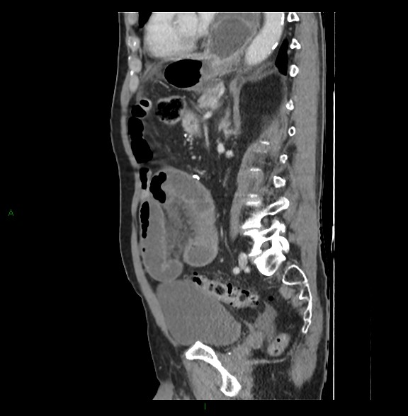Closed loop small bowel obstruction with ischemia (Radiopaedia 84180-99456 C 56).jpg