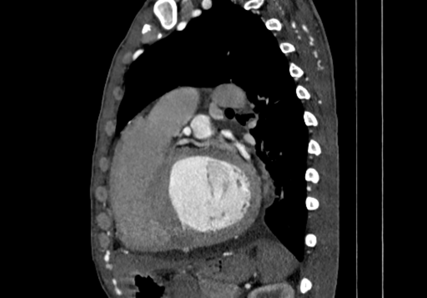 Coarctation of aorta with aortic valve stenosis (Radiopaedia 70463-80574 B 110).jpg