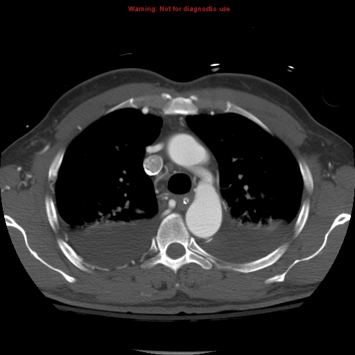 File:Coarctation of the aorta (Radiopaedia 8681-9490 B 22).jpg