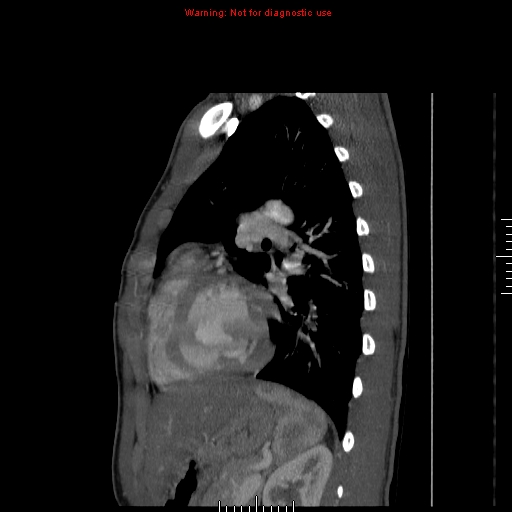 File:Coarctation of the aorta (Radiopaedia 9434-10118 B 41).jpg