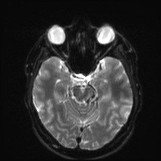 Cochlear incomplete partition type III associated with hypothalamic hamartoma (Radiopaedia 88756-105498 Axial DWI 15).jpg