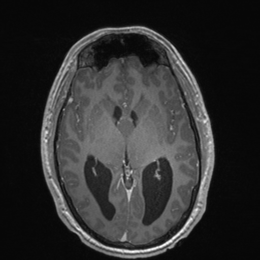 File:Colloid cyst (Radiopaedia 44510-48181 Axial T1 C+ 89).png