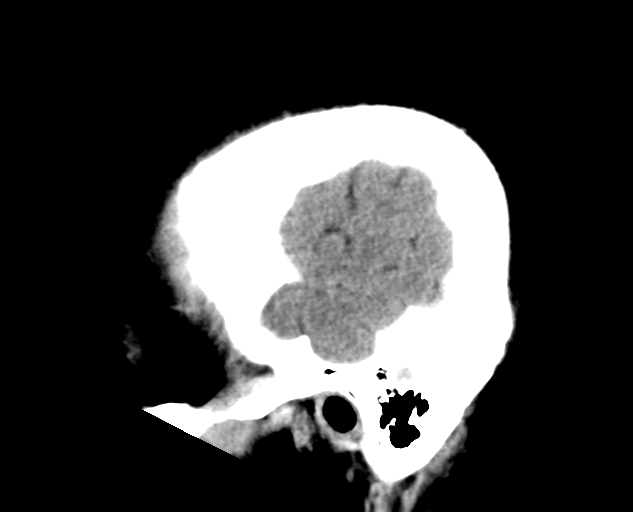 File:Colloid cyst of the third ventricle (Radiopaedia 86571-102661 B 29).png