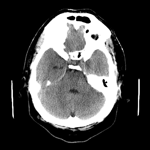 File:Colloid cyst with anterior communicating artery aneurysm (Radiopaedia 33901-35090 Axial non-contrast 6).jpg