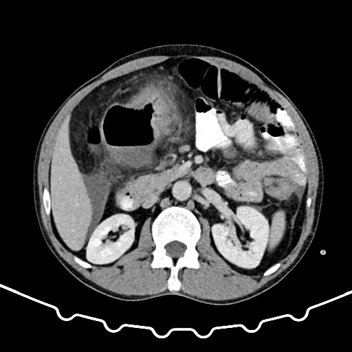 File:Colocolic intussusception due to large lipoma (Radiopaedia 68773-78482 A 69).jpg