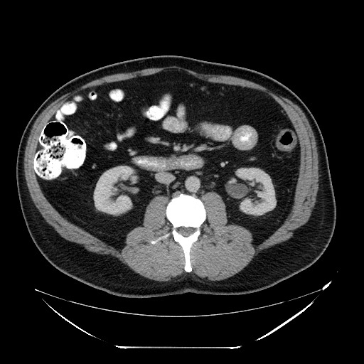 Colocolic intussusception due to lipoma (Radiopaedia 73712-84508 A 53).jpg