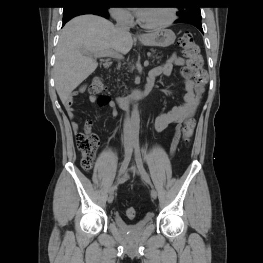 File:Colocutaneous fistula in Crohn's disease (Radiopaedia 29586-30093 Coronal non-contrast 15).jpg
