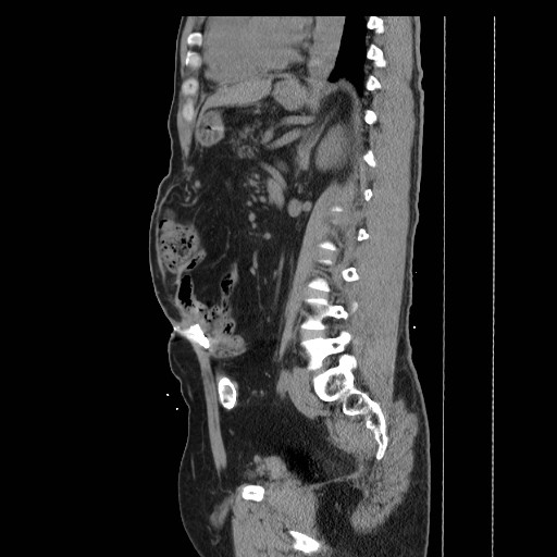 Colocutaneous fistula in Crohn's disease (Radiopaedia 29586-30093 F 25).jpg