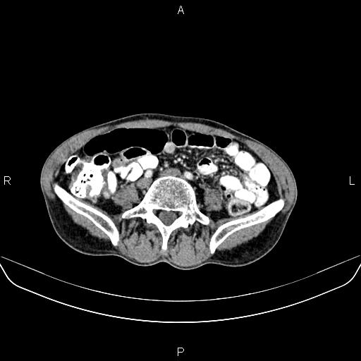 Colon adenocarcinoma - hepatic flexure (Radiopaedia 85635-101395 A 60).jpg