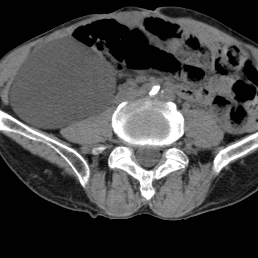 Colon cancer with calcified liver metastasis (Radiopaedia 74423-85309 Axial non-contrast 67).jpg