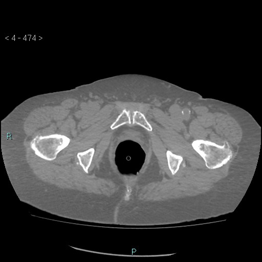 Colonic lipomas (Radiopaedia 49137-54244 Axial bone window 212).jpg