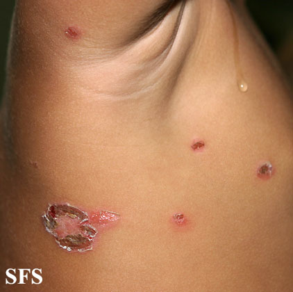 File:Impetigo (Dermatology Atlas 30).jpg