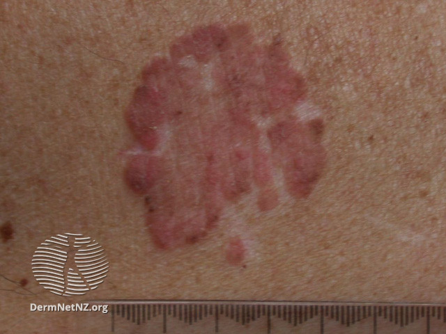 Intraepidermal carcinoma (DermNet NZ lesions-scc-in-situ-2919).jpg