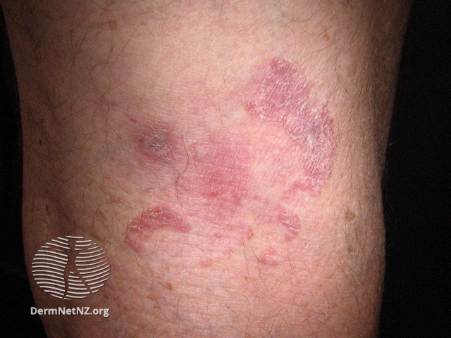 File:Intraepidermal carcinoma (DermNet NZ lesions-scc-in-situ-2965).jpg
