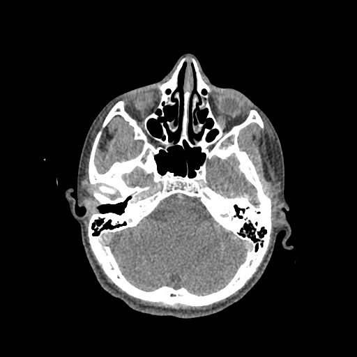 File:Nasal pyogenic granuloma (lobular capillary hemangioma) (Radiopaedia 85536-101244 C 98).jpg