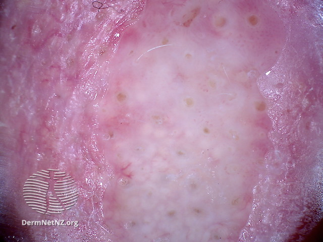 File:Nasal tip lesion with whitish background, some preservation of follicular plugging and sebaceous hyperplasia (DermNet NZ morphoeic-bcc3).jpg