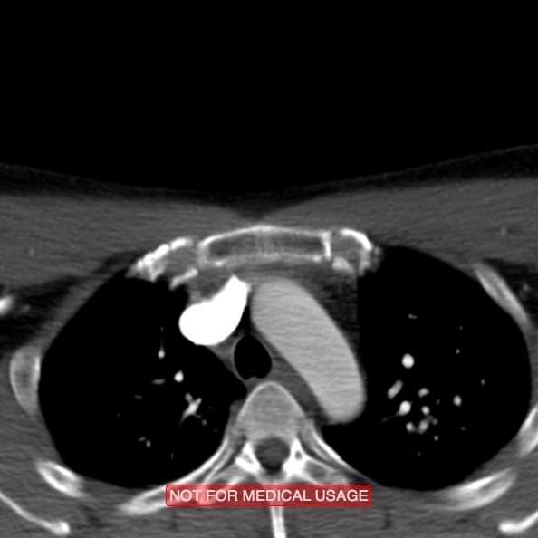 File:Nasopharyngeal carcinoma recurrence - skull base destruction (Radiopaedia 29107-29491 A 43).jpg
