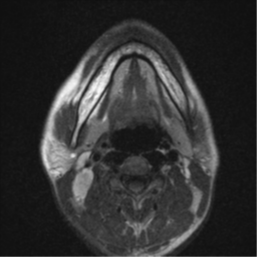 File:Nasopharyngeal carcinoma with pterygopalatine fossa involvement (Radiopaedia 33102-34134 Axial T2 4).png
