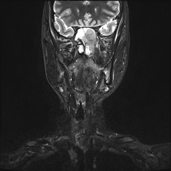 Nasopharyngeal carcinoma with skull base invasion (Radiopaedia 53415-59485 Coronal T2 fat sat 25).jpg