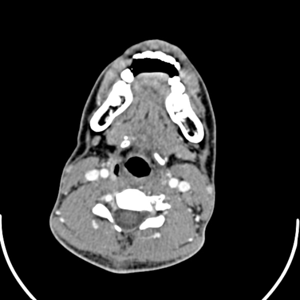 File:Nasopharyngeal carcinoma with skull base invasion (Radiopaedia 53415-59705 A 127).jpg