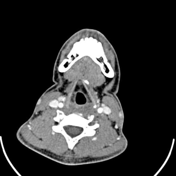 Nasopharyngeal carcinoma with skull base invasion (Radiopaedia 53415-59705 A 141).jpg