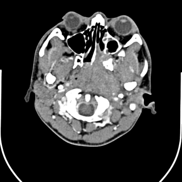 Nasopharyngeal carcinoma with skull base invasion (Radiopaedia 53415-59705 A 38).jpg