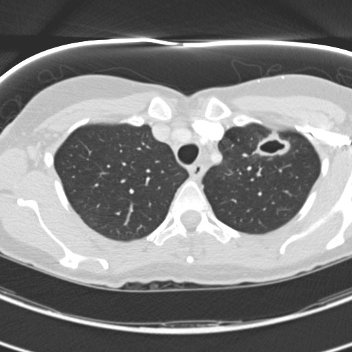 Necrobiotic pulmonary nodules - Crohn disease (Radiopaedia 20723-20631 Axial lung window 31).jpg