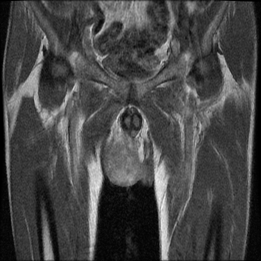 File:Necrotizing epididymo-orchitis with intra-testicular abscess (Radiopaedia 29397-29860 Coronal T1 C+ 10).jpg