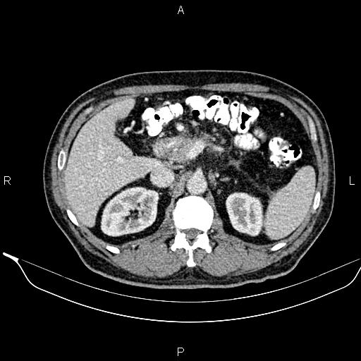 Necrotizing pancreatitis (Radiopaedia 87796-104249 A 20).jpg