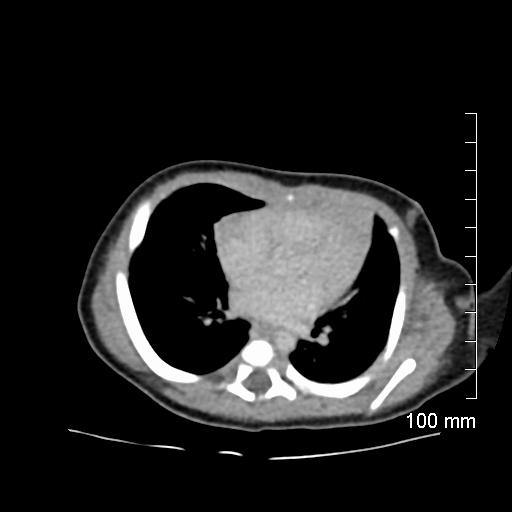 File:Neonatal neuroblastoma (Radiopaedia 56651-63438 Axial non-contrast 2).jpg