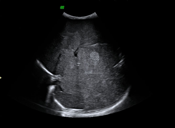 File:Neonatal neuroblastoma (Radiopaedia 9564-10221 A 1).jpg