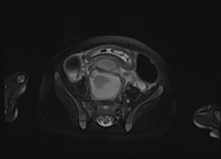 Neonatal prostatic utricle abscess - cyst (Radiopaedia 69511-79394 Axial T2 fat sat 28).jpg