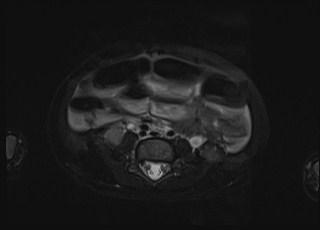 Neonatal prostatic utricle abscess - cyst (Radiopaedia 69511-79394 Axial T2 fat sat 37).jpg