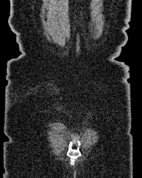 File:Nephrostomy for urosepsis (Radiopaedia 26180-26330 non-contrast 85).jpg