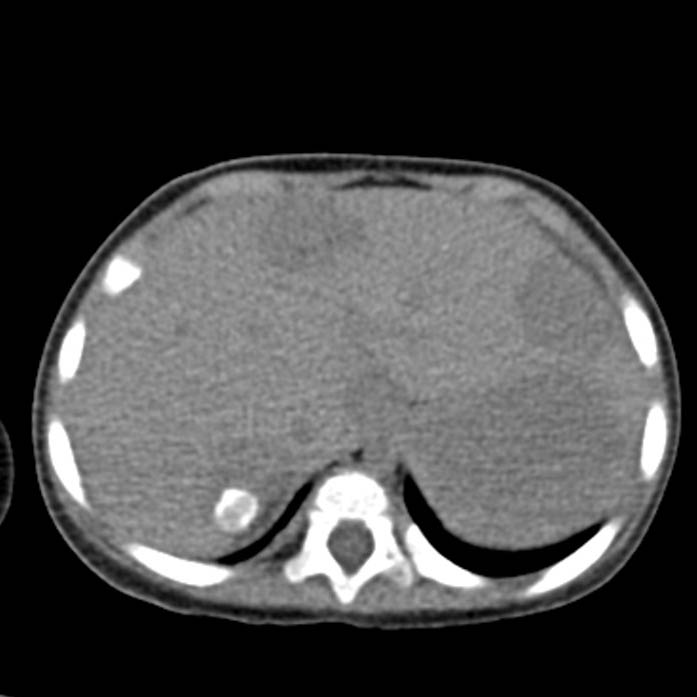 Neuroblastoma with skull metastases (Radiopaedia 30326-30960 Axial non-contrast 9).jpg