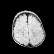 File:Neurofibromatosis type 1 (Radiopaedia 30089-30671 Axial FLAIR 18).jpg