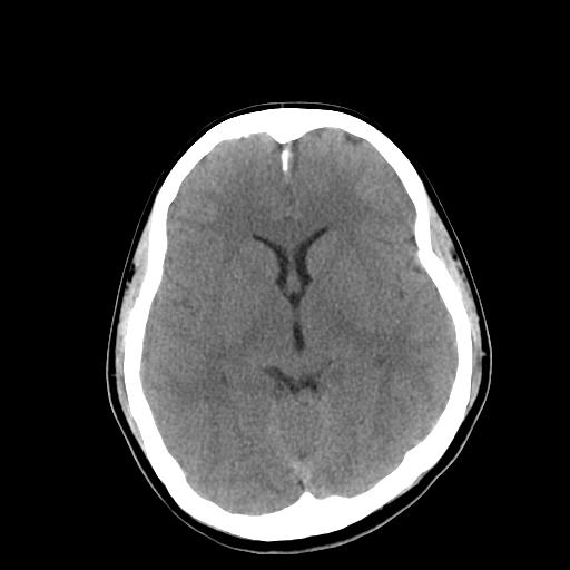 File:Neurofibromatosis type 2 (Radiopaedia 25389-25637 Axial non-contrast 12).jpg
