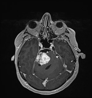 Neurofibromatosis type 2 (Radiopaedia 79097-92049 Axial T1 C+ 68).jpg