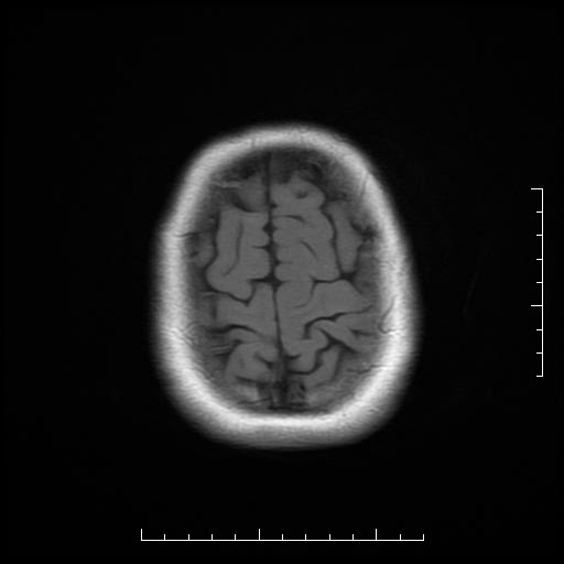 File:Neuroglial cyst of brainstem (Radiopaedia 29134-29526 Axial T1 19).jpg